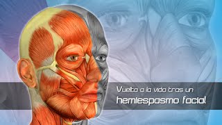 Hemiespasmo Facial Clínica Las Condes [upl. by Yorled777]