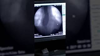 Barium swallow abnormalities [upl. by Htidirem]