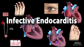 Infective Endocarditis Animation [upl. by Schroeder]