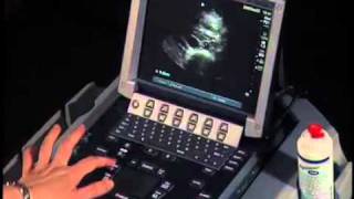 How To Abdominal Ultrasound  Aorta Measurements [upl. by Atat]