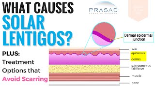 Causes and Treatments for Solar Lentigos [upl. by Aerbma]