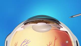 What to Know about the Light Adjustable Lens for Cataract Surgery with Dr Berdahl [upl. by Nnylrahc]