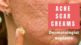 Acne Scar Creams  Dermatologist Reviews [upl. by Borreri]