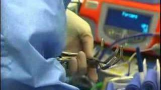 Robot Assisted NephroUreterectomy [upl. by Biebel164]