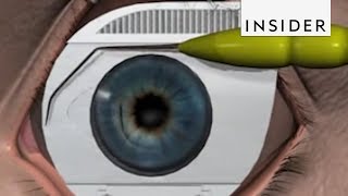 How LASIK Eye Surgery Is Performed [upl. by Scarlett563]