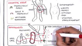 Septic Arthritis  Overview causes pathophysiology treatment [upl. by Claudianus13]