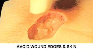 Enzymatic Debridement Demonstration Understand Wound Care [upl. by Aicak15]