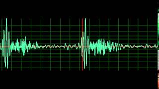 Mitral Regurgitation normal speed [upl. by Acessej291]