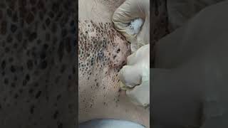 Nevus Comedonicus removal [upl. by Abert]