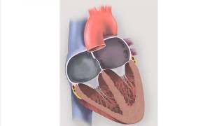 Atrial Septal Defect  Heart Auscultation  Episode 7 [upl. by Sivrat]