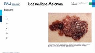 Dermatologie ─ Malignes Melanom [upl. by Ardnuassac]