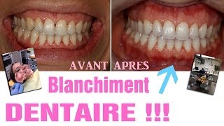 Blanchiment dentaire  AVANTAPRES Revue 25 [upl. by Yolanda492]