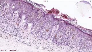 Superficial Spreading Melanoma  Histopathology [upl. by Ame]