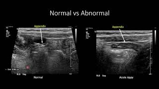 US for Suspected Appendicitis in Children [upl. by Odnomar]