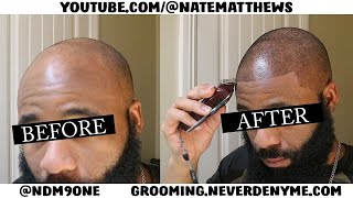 How To Get Your Hairline Back  From Bald To Edge Up  Hairline Restoration [upl. by Arne]