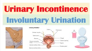 How to Help Clear an Intestinal Blockage [upl. by Paresh]