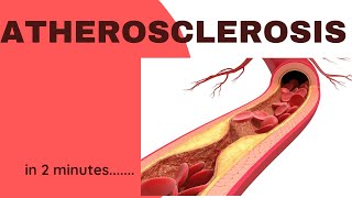 Atherosclerosis in 2 minutes [upl. by Sucramel]