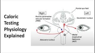 Caloric Testing Explained [upl. by Rotman390]