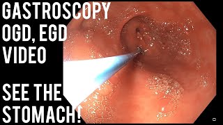 upper gastrointestinal endoscopy procedure [upl. by Marra]