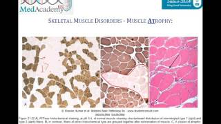 Idiopathic Inflammatory Myopathies  Polymyositis vs Dermatomyositis [upl. by Gnilhsa]