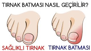 TIRNAK BATMASI NASIL GEÇİRİLİR [upl. by Etterual]