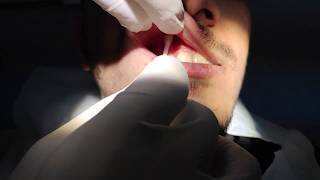 Maxillary Infiltration Anesthesia Technique [upl. by Boutis506]