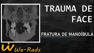 Trauma de Face  Fratura de Mandíbula [upl. by Aset]