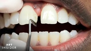 How Tooth Gaps Are Filled  Insider Art [upl. by Pruter]