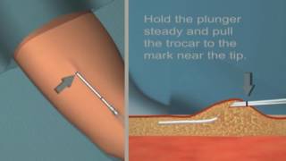 Jadelle insertion and removal Tutorial [upl. by Cibis475]