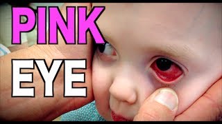 PINK EYE Live Diagnosis Conjunctivitis  Dr Paul [upl. by Greenfield890]