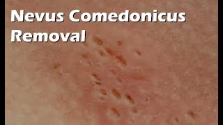 Nevus Comedonicus Removal  9 minutes worth [upl. by Dasha921]