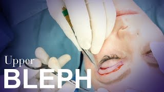 Upper Eyelid Blepharoplasty [upl. by Cordy205]