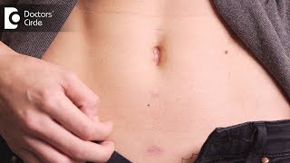 Do’s amp Don’t’s after Laparoscopic Surgery  Wound healing Tips Dr Nanda Rajneesh Doctors Circle [upl. by Lilyan]