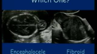 Congenital Cardiac Defect Medical Definition  Heart Abnormalities at Birth [upl. by Abibah]