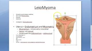 Pathology 721 a Leiomyoma FIBROID uterus fibromyoma Smooth muscle benign Gross specimen Practical [upl. by Nnayelsel]