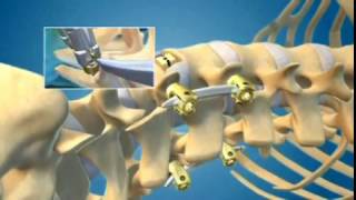 Endoscopic Lumbar Laminotomy  Spine Institute of North America [upl. by Evatsug134]