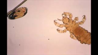 Pediculosis Head and body lice [upl. by Dolli]