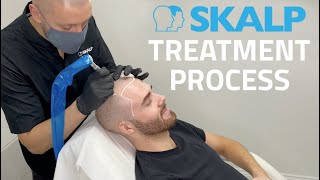 Skalp® Scalp Micropigmentation Treatment Process [upl. by Threlkeld513]