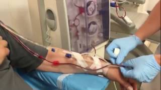 Dialysis connection of a patient with an arteriovenous fistula [upl. by Ecirtal]