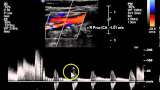 Subclavian Artery Branches  Mnemonic Series 14 [upl. by Jurdi]