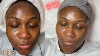 Hyperpigmentation Correction w Microdermabrasion [upl. by Mindi]