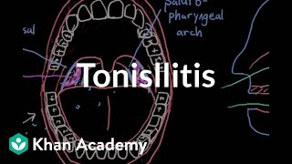 Urgent ENT Problems Peritonsillar Abscess [upl. by Gader]