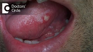 What are different circularlesions present on tongue  Dr Jayaprakash Ittigi [upl. by Dalila707]