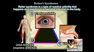 Reiters Syndrome Reactive Arthritis  Everything You Need To Know  Dr Nabil Ebraheim [upl. by Yornek]