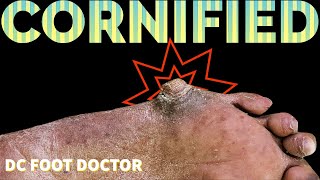 Cornified Extremely Thick and Hard Callus Removal [upl. by Attekram805]