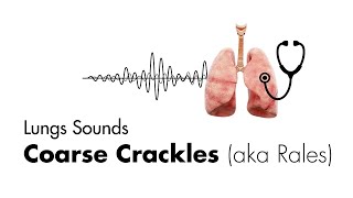 Coarse Crackles Rales  Lung Sounds  Medzcool [upl. by Pius]