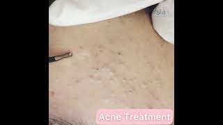 Comedone Extraction Acne Treatment [upl. by Sirah]