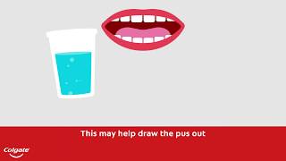 How To Treat a Gum or Tooth Abscess  Colgate® [upl. by Lunt948]