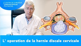 HERNIE DISCALE CERVICALE  En quoi consiste lopération [upl. by Ellehcan]