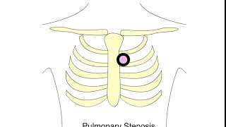 Pulmonary stenosis murmur [upl. by Nediarb]